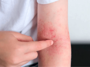 cuidado-com-a-pele:-especialista-explica-sintomas-e-tratamento-da-dermatite-atopica
