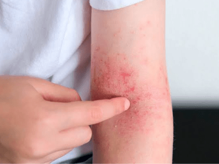 cuidado-com-a-pele:-especialista-explica-sintomas-e-tratamento-da-dermatite-atopica