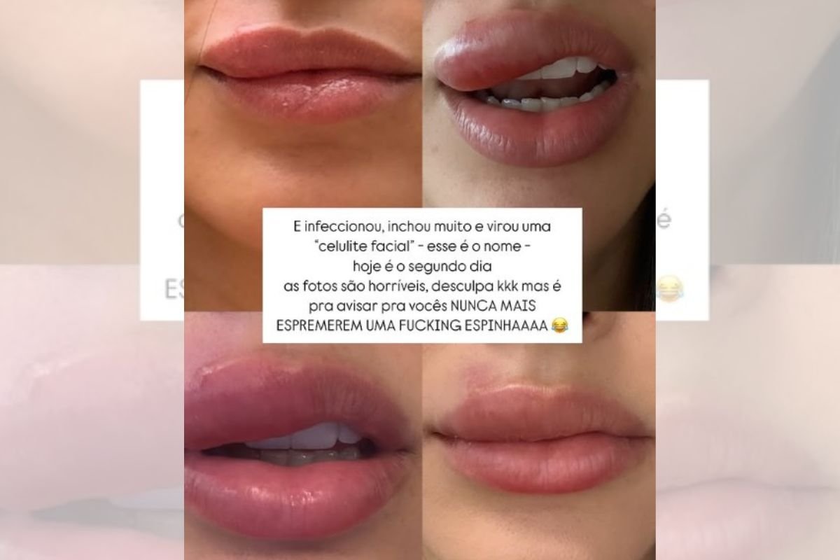 print colorido de como ficou a boca de Bruna Biancardi ao espremer espinha