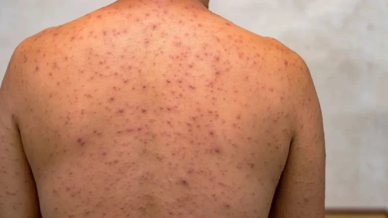 Acre confirma primeiro caso de Mpox no interior