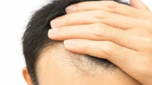 Cabelo transplantado pode cair? Veja alguns detalhes sobre o procedimento