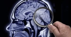 Estudo identifica proteína que acelera desenvolvimento do Alzheimer