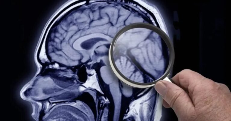 Estudo identifica proteína que acelera desenvolvimento do Alzheimer