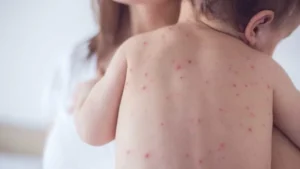 Bebê com quadro vacinal incompleto é o 32º caso de sarampo em SP; veja onde se vacinar