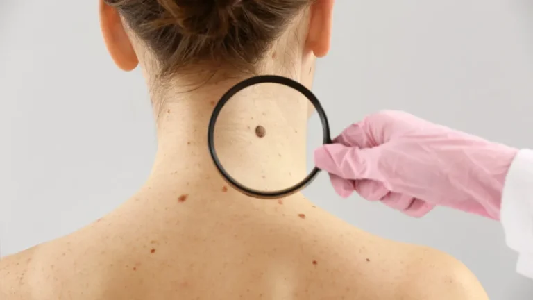 Câncer: estudo alerta para riscos de melanoma fora da pele