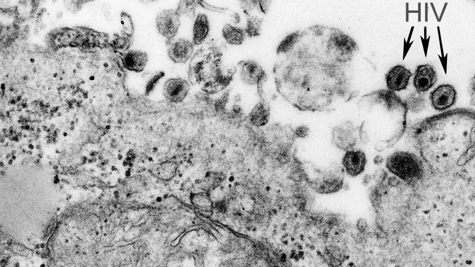 Vírus HTLV-1 causa síndrome inflamatória em assintomáticos, aponta estudo
