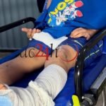 Criança é atropelada no Segundo Distrito e motociclista sofre amputação de dedo