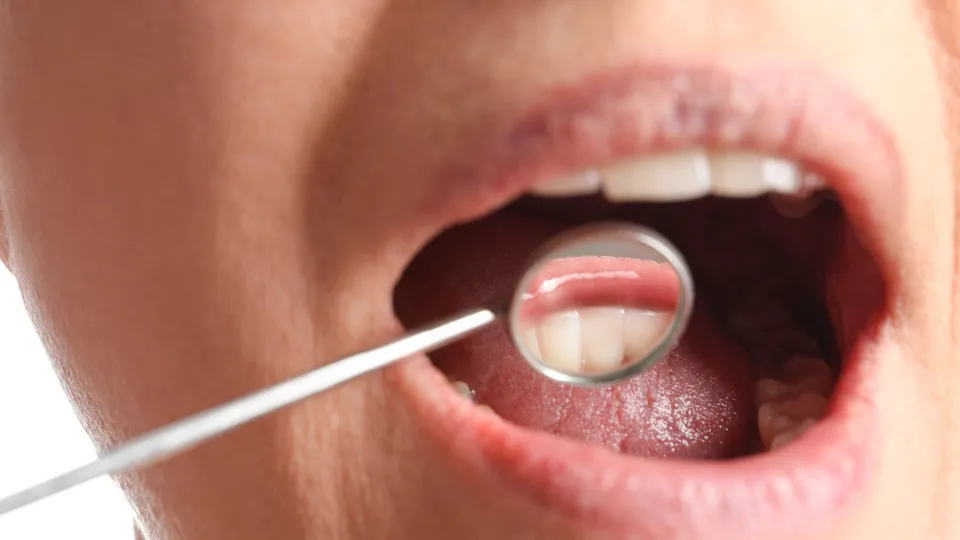 Acúmulo de tártaro: o que faz algumas pessoas terem mais do que outras?